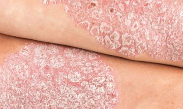 Skin rash? It might be Psoriasis