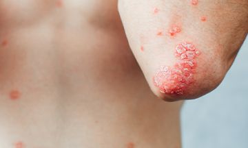Eczema vs Psoriasis — Know the difference.