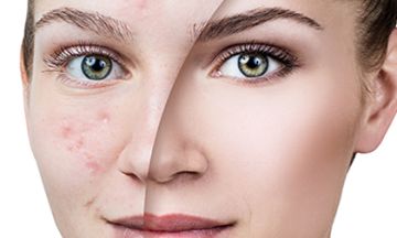 Homeopathy — Best Remedy for Acne.