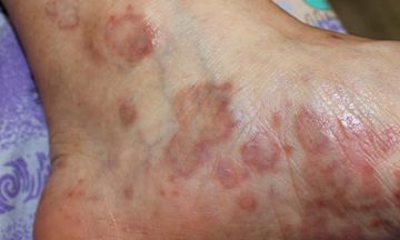 Lichen Planus & Depression — What's the Connection?