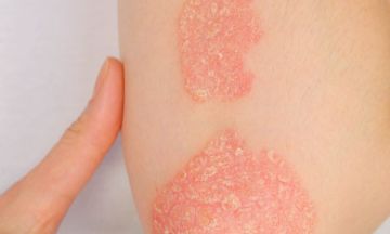 Signs to know if you've psoriasis