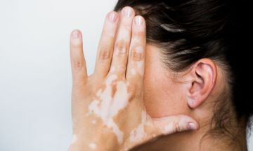 What Does Vitiligo Look Like?