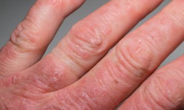 Can psoriasis lead to arthritis?