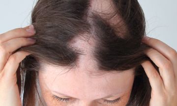 Causes of Alopecia