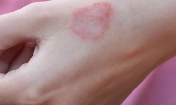 Treatment for skin allergy at home
