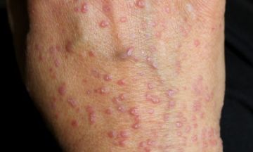 Can Lichen Planus be itchy?