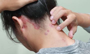 How to treat Seborrhoeic Dermatitis?