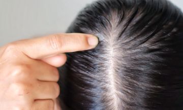 Causes of hair loss in women