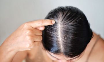 Female Pattern Baldness Symptoms Stages Causes  Treatment