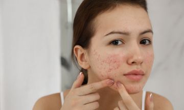 Homeopathy: Acne healing warrior