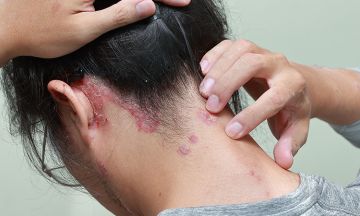All you need to know about scalp psoriasis
