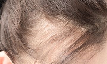 Signs of baldness in women