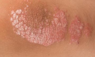 Psoriasis kezelése hindi