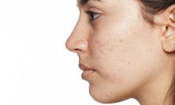 What is the best treatment for acne?