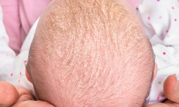 Scalp psoriasis in children