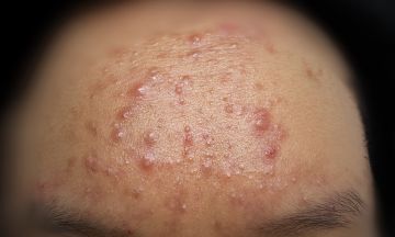 How to treat monsoon acne?