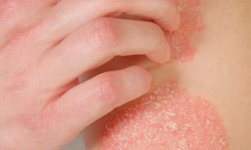 How to prevent psoriasis from recurring?