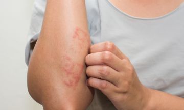 How to get rid of eczema?