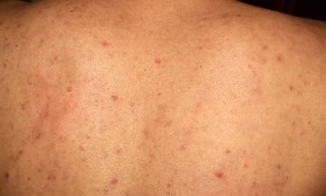 How to get rid of pimples on your back?