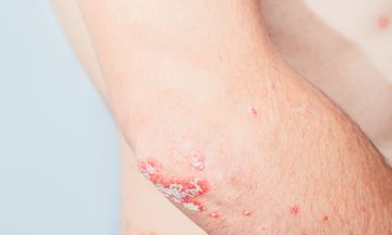 Psoriasis & Gluten