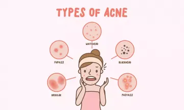 Different types of acne and their homeopathic remedy.