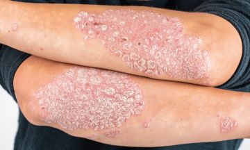 Can soaking in Epsom salts soothe psoriasis symptoms?
