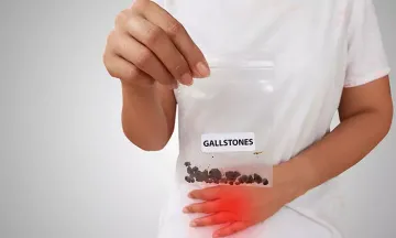 Roll out gallstones using homeopathy