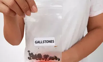 Roll out gallstones using homeopathy