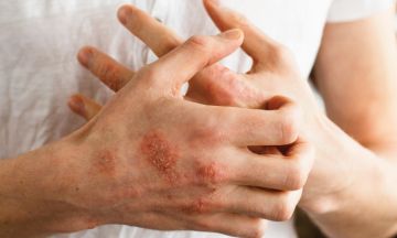 10 things to know about eczema