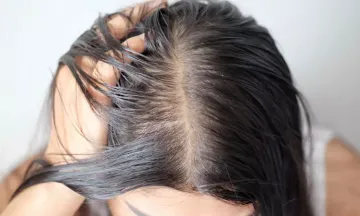 Female Pattern Baldness in your 20s? | Dr Batra's™