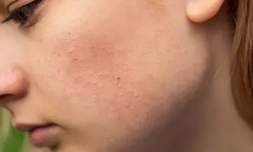10 most common skin disorders