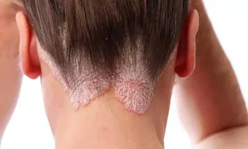 Here’s What You Should Know About Scalp Psoriasis
