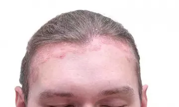 All about Scalp Psoriasis