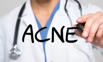 Here’s 7 Reasons Why You Have Adult Acne