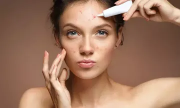 7 TIPS TO MANAGE ACNE