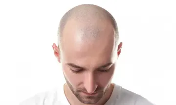 Homeopathy Effectively Treats Alopecia Totalis Homeopathy Effectively Treats Alopecia Totalis