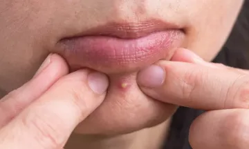 Can popping a pimple lead to acne scars?