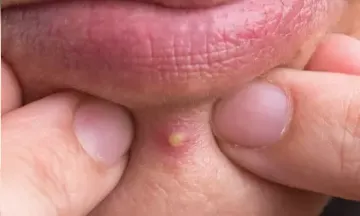 Can popping a pimple lead to acne scars?
