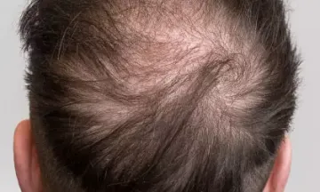10 things you should know about male pattern baldness