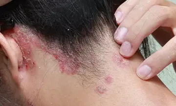 Best shampoos for scalp psoriasis