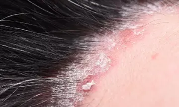 Do over-the-counter drugs work for scalp psoriasis?