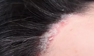 Do over-the-counter drugs work for scalp psoriasis?