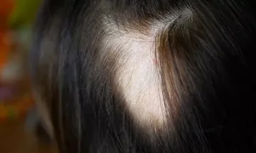 Is alopecia areata permanent?