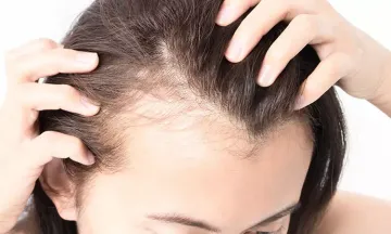 Does dengue fever cause hair loss?