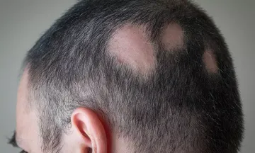 Early signs of alopecia areata