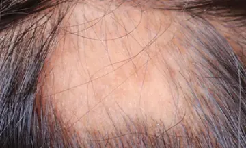 Facts about patchy hair loss