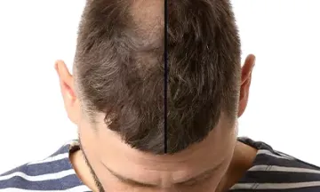 Homeopathy: Best hair loss treatment for men