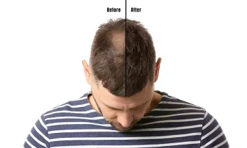 Homeopathy: Best hair loss treatment for men