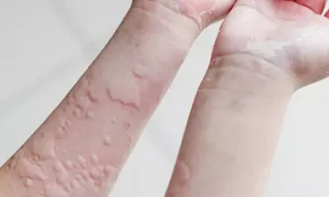 Homeopathy: Best treatment for skin allergy