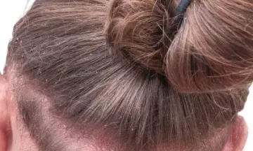 Can scalp psoriasis cause red spots?